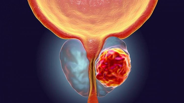 Día Mundial del Cáncer de Próstata: El diagnóstico oportuno es la clave para mejorar su tendencia al alza en Chile