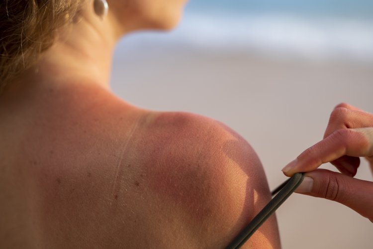 Evita la insolación en verano: consejos clave