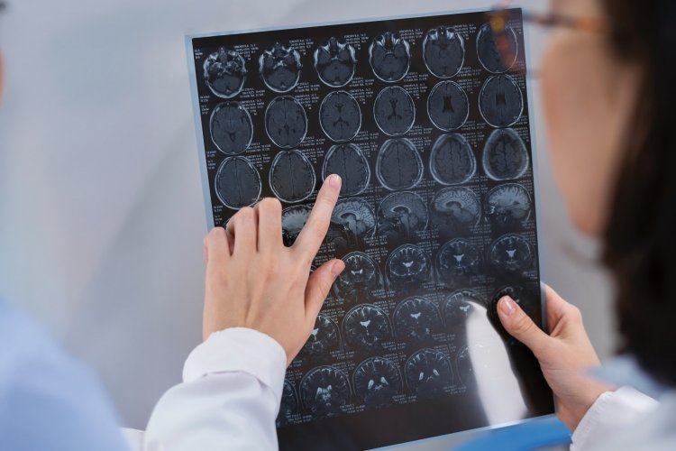 Enfermedades del cerebro en Chile: ACV y demencia