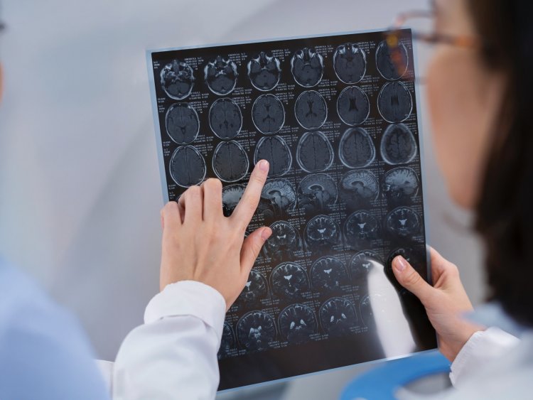 Enfermedades del cerebro: ¿cuáles son las más comunes en Chile?