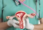 Cáncer cérvico uterino en Chile: Realidad y prevención