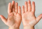 Enfermedad boca-mano-pie: qué hacer ante un contagio y cuáles son sus señales de alerta
