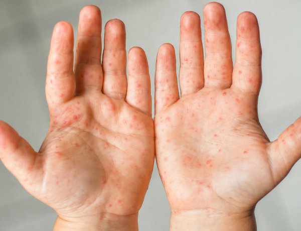 Enfermedad boca-mano-pie: qué hacer ante un contagio y cuáles son sus señales de alerta
